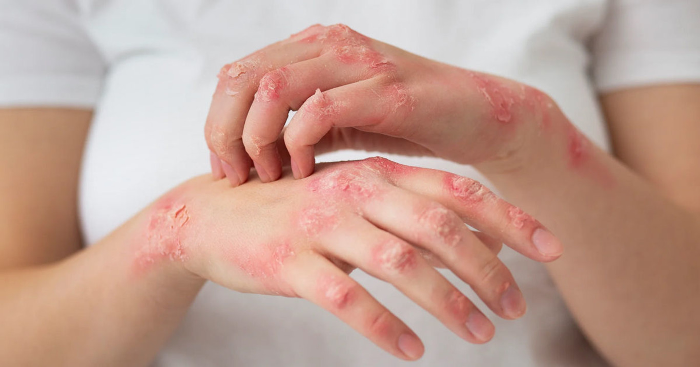 людина з хворобою лепри