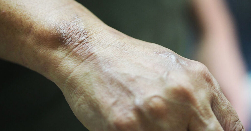 людина із проказою