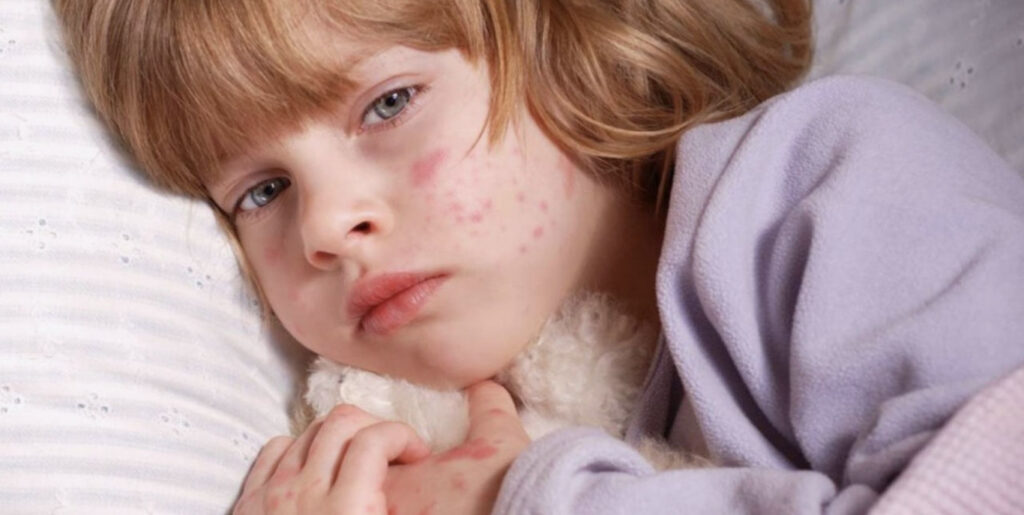 дитина хвора на кір